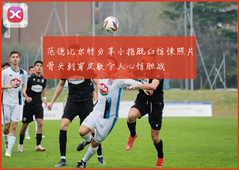 范德比尔特分享小指脱臼惊悚照片骨头刺穿皮肤令人心惊胆战